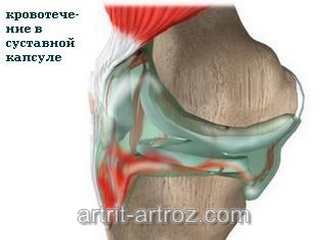 изображение травмированного коленного сустава