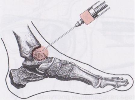 изображение голеностопного сустава