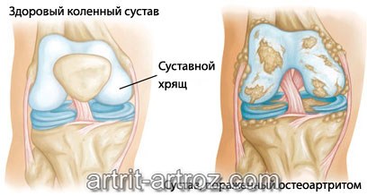 схема заболевания артрит коленного сустава