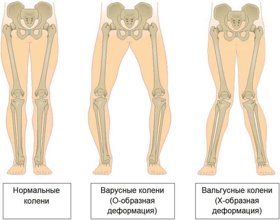 деформации колена