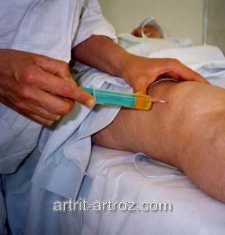 инъекция в коленный сустав