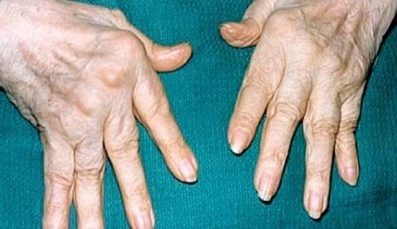 больние пальцы