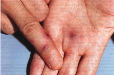 фото с больными суставами пальцев