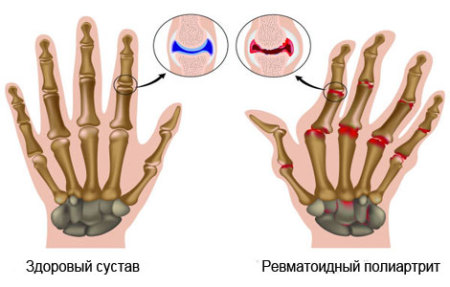 инстраграма здоровых и больных суставов пальцев