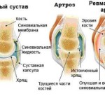 Артрозо-артрит: лечение болезни в коленном, голеностопном и других суставах