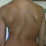 Сколиоз 4 степени: последствия и фото деформации спины