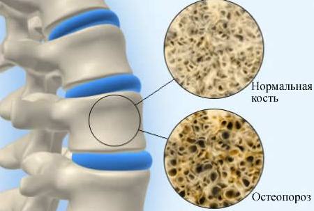 поврежденная остеопорозом кость