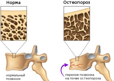 кости при остеопорозе