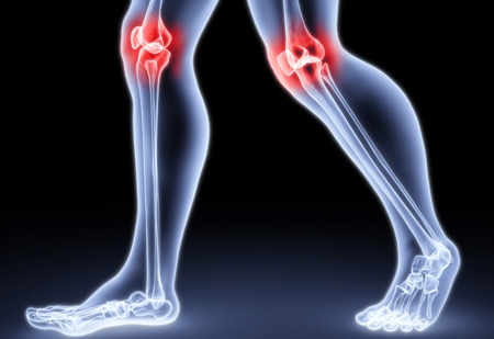 артроз коленного сустава