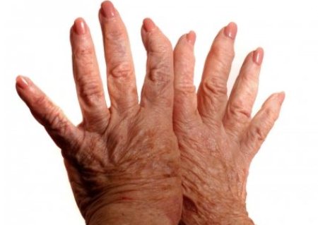 деформация рук при ревматоидном артрите