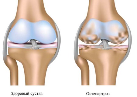 Изображение - Деструктивные изменения суставов osteoartroz-sustavov