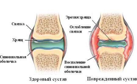 разрушение сустава при артрите