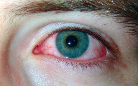 воспаление глаза